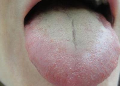 هشدار؛ سفید شدن زبان زنگ خطر این بیماری هاست!